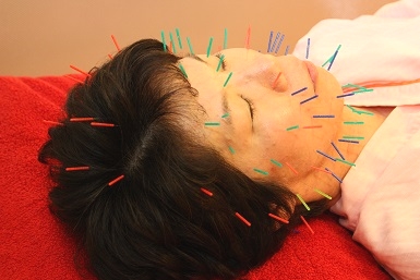 顔の美容鍼の写真